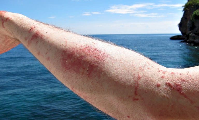 Beware! Jellyfish season in the Philippines is a Killer Jellyfish attack