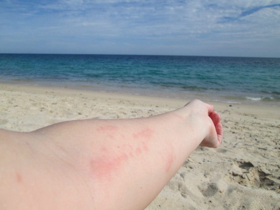 jellyfish-sting